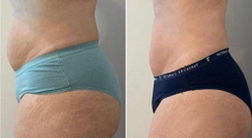 Before-and-After-Fat-Transfer-Surgery