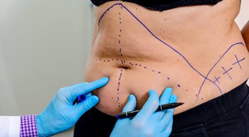 Fat-Transfer-Surgery2