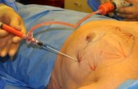 Fat-Transfer-Surgery3