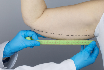 arm-lift-surgery-procedure