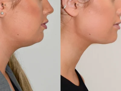 double-chin-reduction10