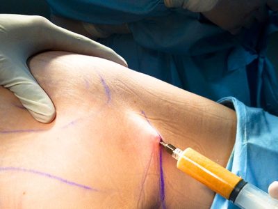 fat-transfer-surgerys