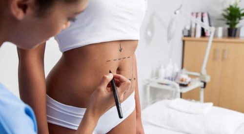 liposuction-consultation2