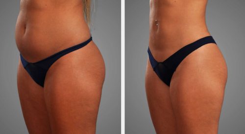 liposuction-post-surgery