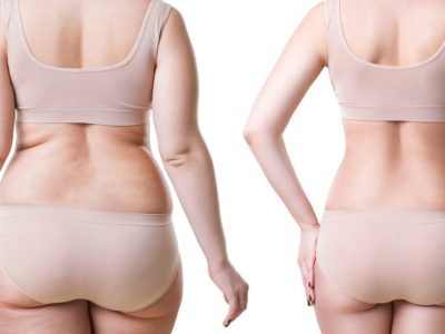 liposuction-post-surgery1