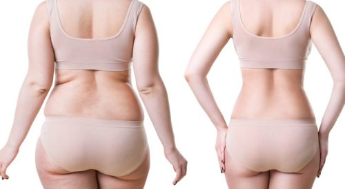 liposuction-post-surgery1