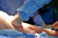 liposuction-surgery