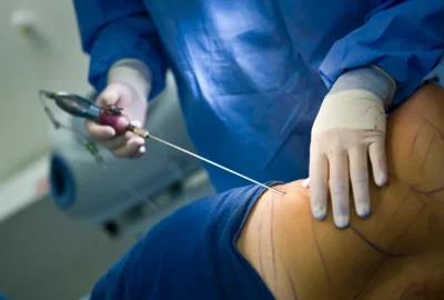 liposuction-surgery
