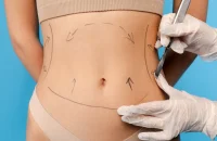liposuction-surgery1