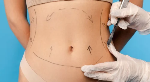 liposuction-surgery1