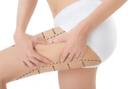 thigh-lift-surgery-consultation