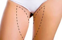 thigh-lift-surgery-consultation1