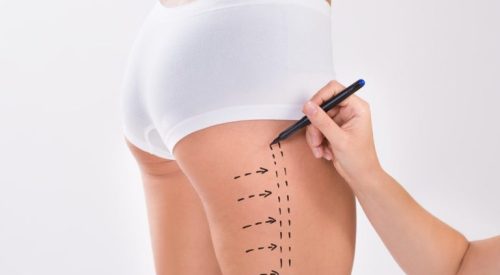thigh-lift-surgery-consultations