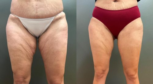 thigh-lift-surgery1